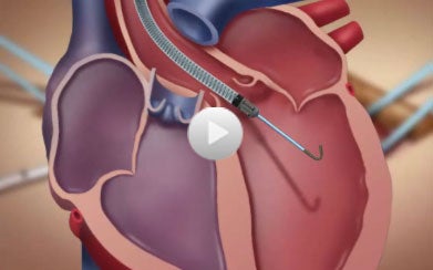 VA hospitals to get streamlined access to its Impella heart products ...