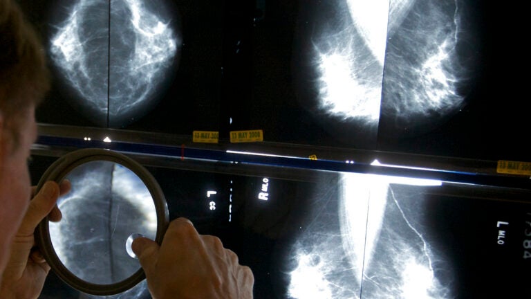 Us To Require Breast Density Information After Mammograms