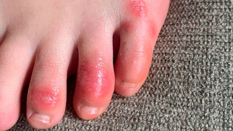 covid rash on foot