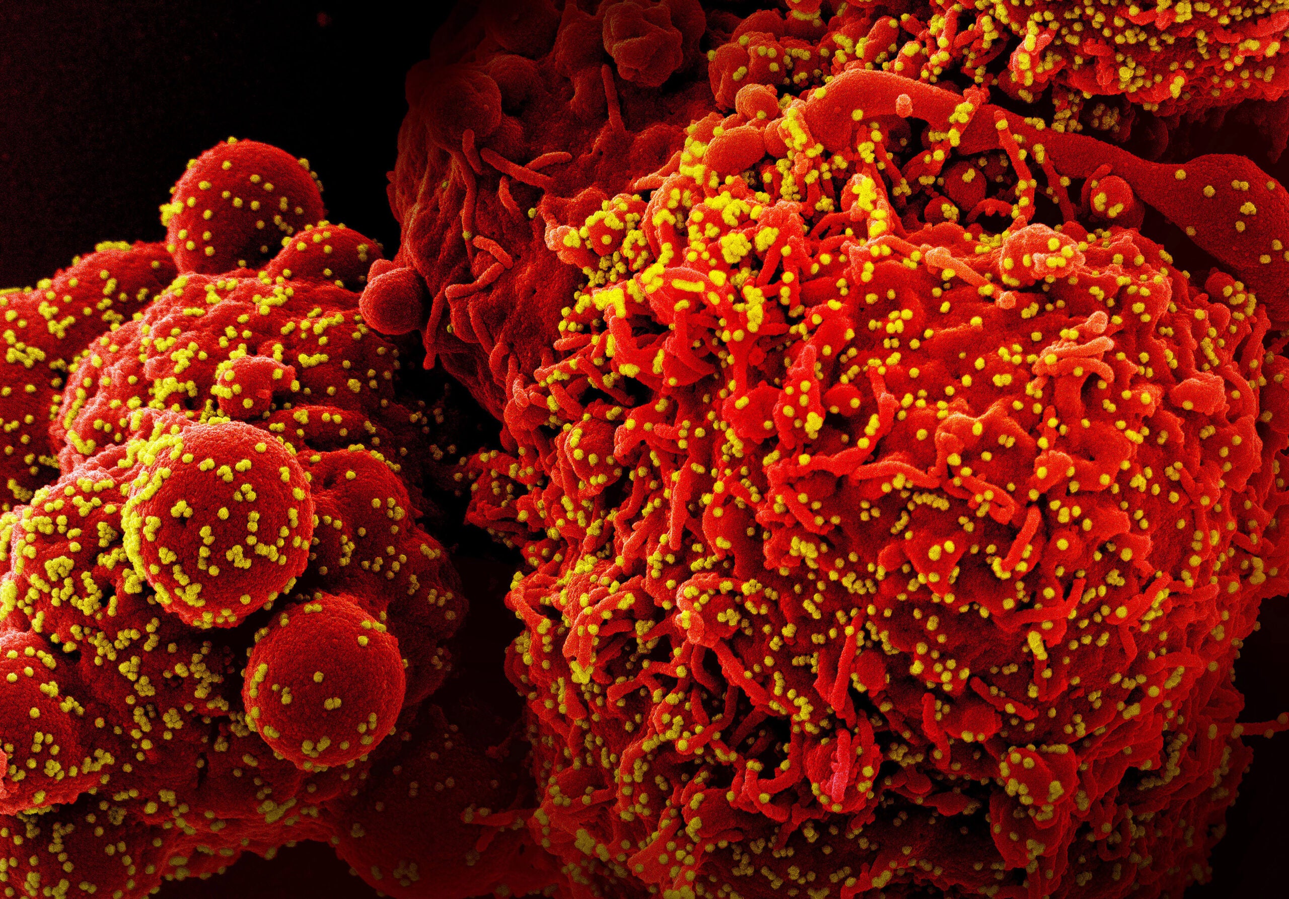 A colorized scanning electron micrograph of a cell (red) infected with Omicron virus particles, yellow. 
