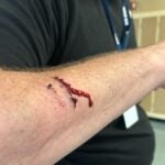 The cut arm of a Revere High School staff member after he attempted to break up a fight Wednesday.