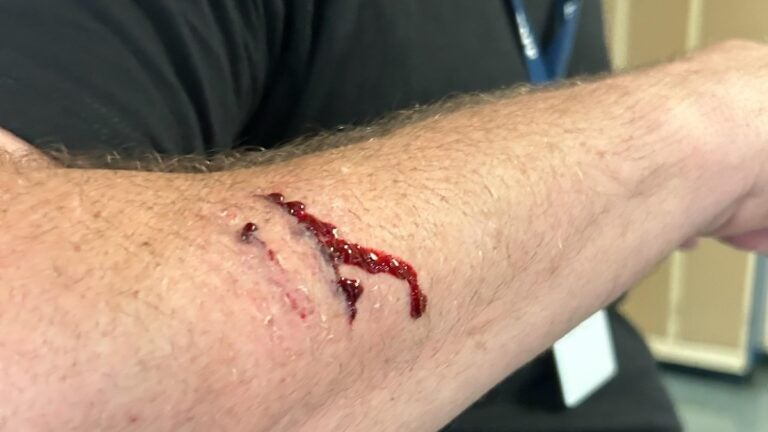 The cut arm of a Revere High School staff member after he attempted to break up a fight Wednesday.