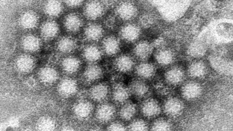 What to know about norovirus with stomach bug cases on the rise